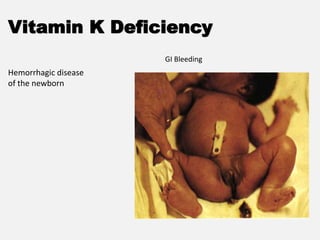 Vitamin K Deficiency
Hemorrhagic disease
of the newborn
GI Bleeding
 