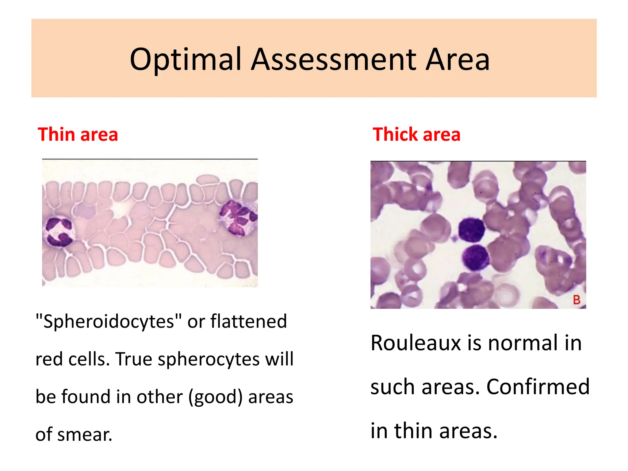 Peripheral blood smeared examination test | PDF