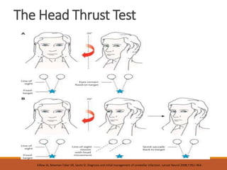 The Head Thrust Test
Edlow JA, Newman-Toker DE, Savitz SI. Diagnosis and initial management of cerebellar infarction. Lancet Neurol 2008;7:951–964.
 