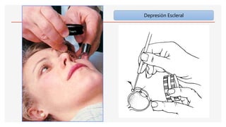 Depresión Escleral
 