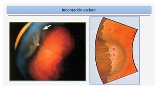 Indentación escleral
 