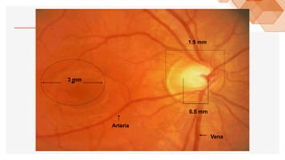 1.5 mm
0.5 mm
3 mm
Vena
Arteria
 