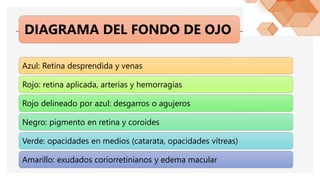 DIAGRAMA DEL FONDO DE OJO
Azul: Retina desprendida y venas
Rojo: retina aplicada, arterias y hemorragias
Rojo delineado por azul: desgarros o agujeros
Negro: pigmento en retina y coroides
Verde: opacidades en medios (catarata, opacidades vítreas)
Amarillo: exudados coriorretinianos y edema macular
 