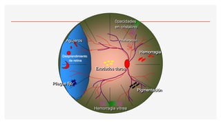 Hemorragia vítrea
Exudados duros
Hemorragia
Desprendimiento
de retina
Agujeros
Pliegue fijo
Pigmentación
Proliferación
0pacidades
en cristalino
 