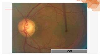 2.- OFTALMOSCOPÍA.pdf123456890123456677