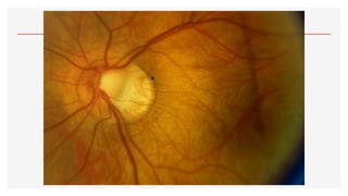 2.- OFTALMOSCOPÍA.pdf123456890123456677