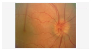 2.- OFTALMOSCOPÍA.pdf123456890123456677