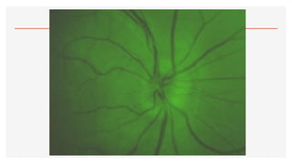 2.- OFTALMOSCOPÍA.pdf123456890123456677