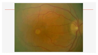 2.- OFTALMOSCOPÍA.pdf123456890123456677