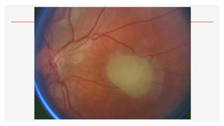 2.- OFTALMOSCOPÍA.pdf123456890123456677