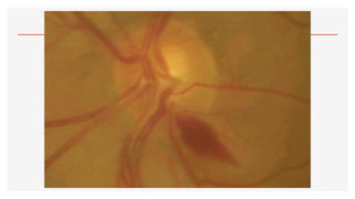 2.- OFTALMOSCOPÍA.pdf123456890123456677