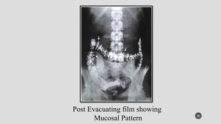 Mucosal Pattern 2.Barium Study of Lower GI TRACT PPT BY RAVINDRA KUMAR.pptx