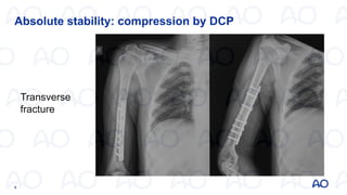plates in fracture fixation on orthopedic | PDF