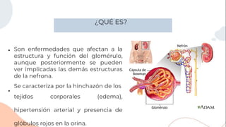 ¿QUÉ ES?
●
tejidos corporales (edema),
hipertensión arterial y presencia de
glóbulos rojos en la orina.
Son enfermedades que afectan a la
estructura y función del glomérulo,
aunque posteriormente se pueden
ver implicadas las demás estructuras
de la nefrona.
Se caracteriza por la hinchazón de los
●
 
