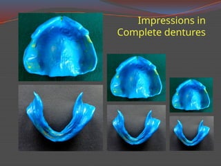 Impressions in complete denture .step wise | PPTX