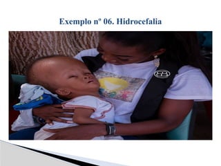 Exemplo nº 06. Hidrocefalia
 