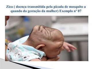 Zica ( doença transmitida pela picada de mosquito a
quando da gestação da mulher) Exemplo nº 07
 