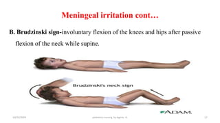 Meningeal irritation cont…
B. Brudzinski sign-involuntary flexion of the knees and hips after passive
flexion of the neck while supine.
17
10/31/2024 pediatrics nursing by Agerie. A.
 