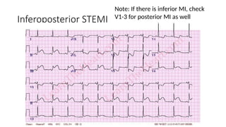 Inferoposterior Infarction 2._ECG.pptxhbjjjjjhhhhhhjjjhhhhhhhhiuuhhhh | PPTX