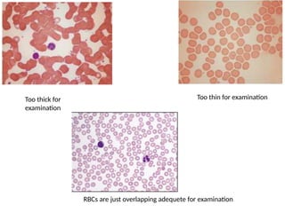 Too thick for
examination
Too thin for examination
RBCs are just overlapping adequete for examination
 