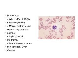 • Macrocytes
• • When MCV of RBC is
• Increased(>100fl)
• • Macro- ovalocytes are
• seen in Megaloblastic
• anemia
• • Myledysplastic
• syndrome.
• • Round Macrocytes seen
• in Alcoholism, Liver
• disease.
 