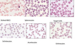 Sickled RBCS Spherocytes Target Cells
Schistocytes
Acantocytes
Echinocytes
 