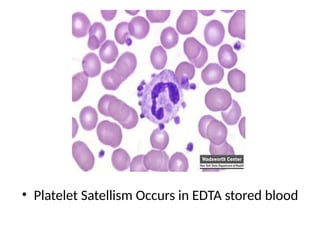 • Platelet Satellism Occurs in EDTA stored blood
 