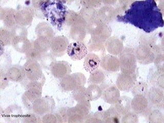 Vivax trophozoite
 