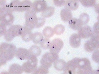 Falciparum trophozoites
 
