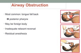 Airway Obstruction
• Most common: tongue fall back
 posterior pharynx
• May be foreign body
• Inadequate relaxant reversal
• Residual anesthesia
 