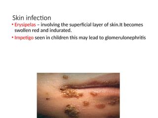 Skin infection
• Erysipelas – involving the superficial layer of skin.It becomes
swollen red and indurated.
• Impetigo seen in children this may lead to glomerulonephritis
 