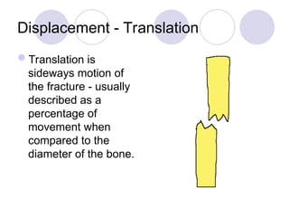 Displacement - Translation
Translation is
sideways motion of
the fracture - usually
described as a
percentage of
movement when
compared to the
diameter of the bone.
 