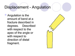 Displacement - Angulation
Angulation is the
amount of bend at a
fracture described in
degrees. Described
with respect to the
apex of the angle or
with respect to
direction of distal
fragment.
 