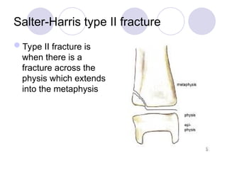 Salter-Harris type II fracture
Type II fracture is
when there is a
fracture across the
physis which extends
into the metaphysis
 