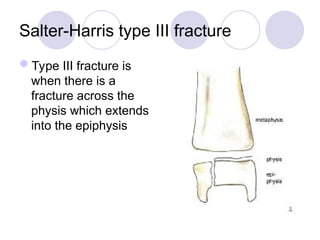 Salter-Harris type III fracture
Type III fracture is
when there is a
fracture across the
physis which extends
into the epiphysis
 