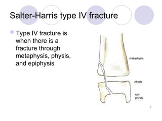 Salter-Harris type IV fracture
Type IV fracture is
when there is a
fracture through
metaphysis, physis,
and epiphysis
 