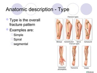 Anatomic description - Type
Type is the overall
fracture pattern
Examples are:
Simple
Spiral
segmental
 