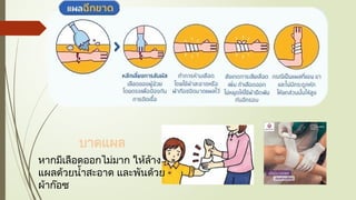 บาดแผล
หากมีเลือดออกไม่มาก ให้ล้าง
แผลด้วยน้ำสะอาด และพันด้วย
ผ้าก๊อซ
 