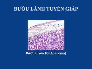 BƯỚU LÀNH TUYẾN GIÁP
Bướu tuyến TG (Adenoma)
 