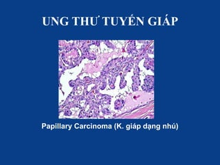 UNG THƯ TUYẾN GIÁP
Papillary Carcinoma (K. giáp dạng nhú)
 