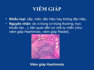 VIÊM GIÁP
• Nhiều loại: cấp, mãn; đặc hiệu hay không đặc hiệu.
• Nguyên nhân: do vi trùng (vi trùng thường; trực
khuẩn lao…), liên quan đến cơ chế tự miễn (như
viêm giáp Hashimoto, viêm giáp Riedel).
Viêm giáp Hashimoto
 