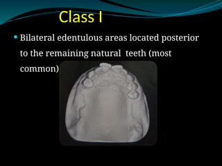 Edentulous Class Rpd 2. kennedys classification IN RPD DENTURE.pptx