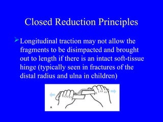Fracture of long bone and it's Rx strategies | PPT
