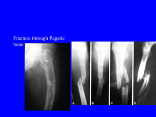 2 Fracture Treatment Principles Gh ppt 2-fracture-treatment-principles-gh-ppt