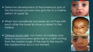 Development of face and anomalies- embryology.pptx