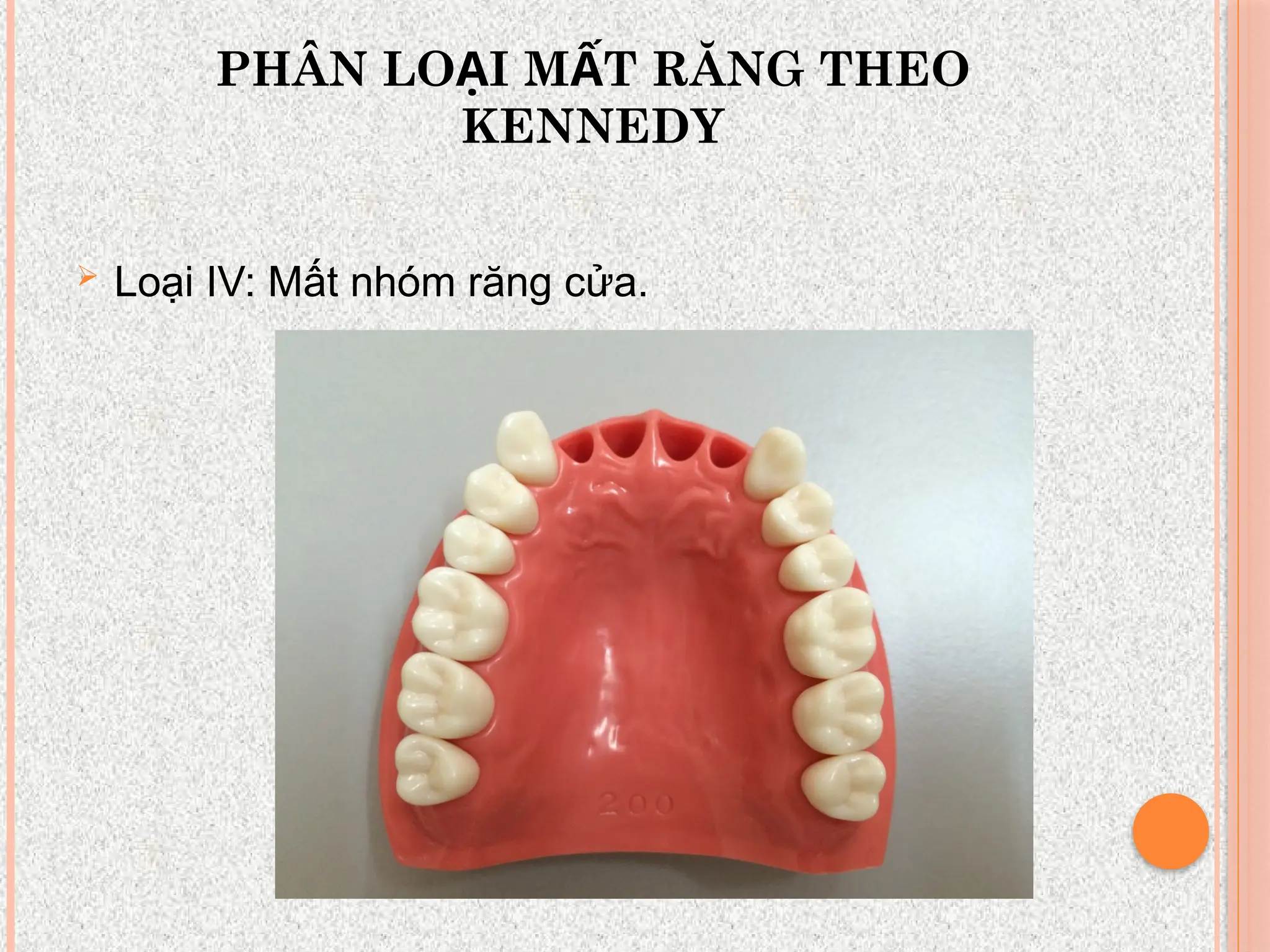 PHÂN LO I M T RĂNG THEO
Ạ Ấ
KENNEDY
 Loại IV: Mất nhóm răng cửa.
 