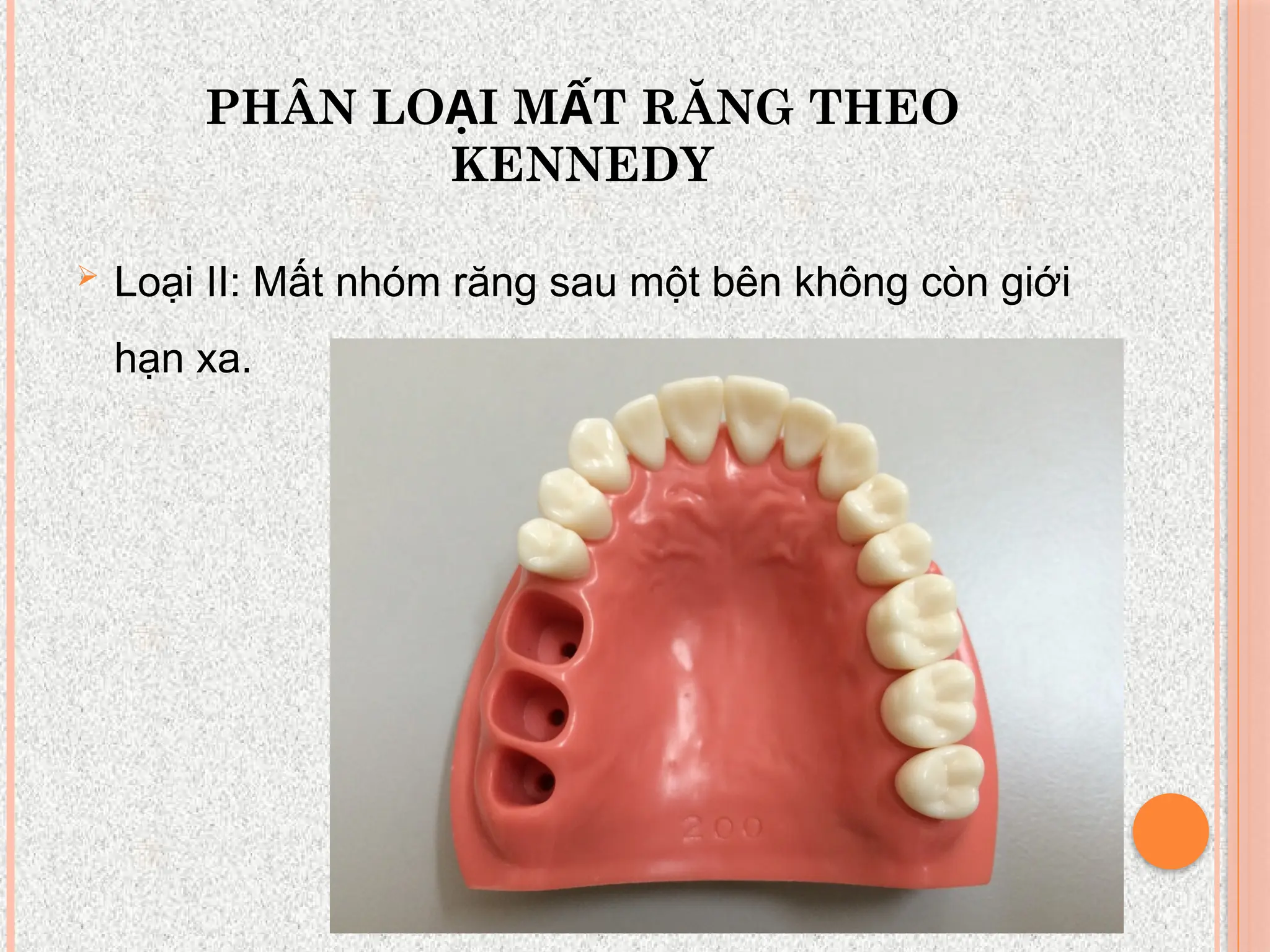 PHÂN LO I M T RĂNG THEO
Ạ Ấ
KENNEDY
 Loại II: Mất nhóm răng sau một bên không còn giới
hạn xa.
 