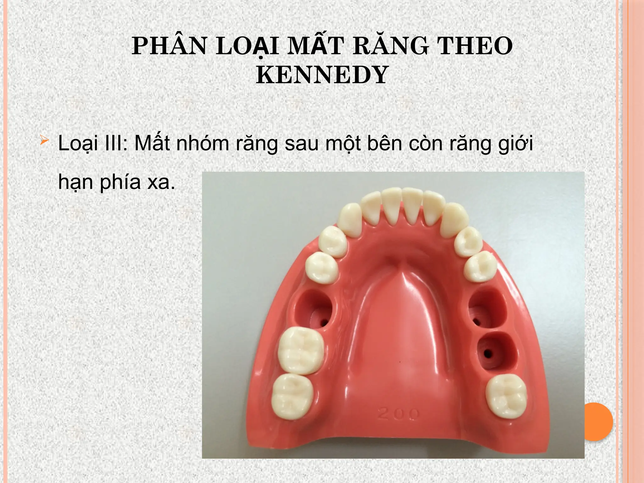 PHÂN LO I M T RĂNG THEO
Ạ Ấ
KENNEDY
 Loại III: Mất nhóm răng sau một bên còn răng giới
hạn phía xa.
 