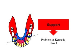 2.Principles of kennedy class IRPD design2025.pptx