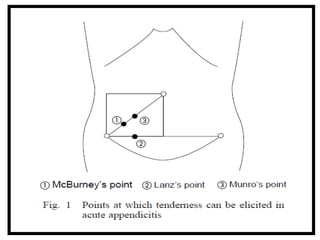 2. Acute appendicitis is the inflammation of vermiform appendix | PPTX